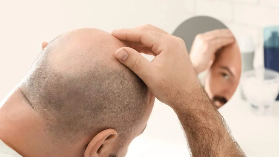 כיצד מבצעים השתלת שיער?