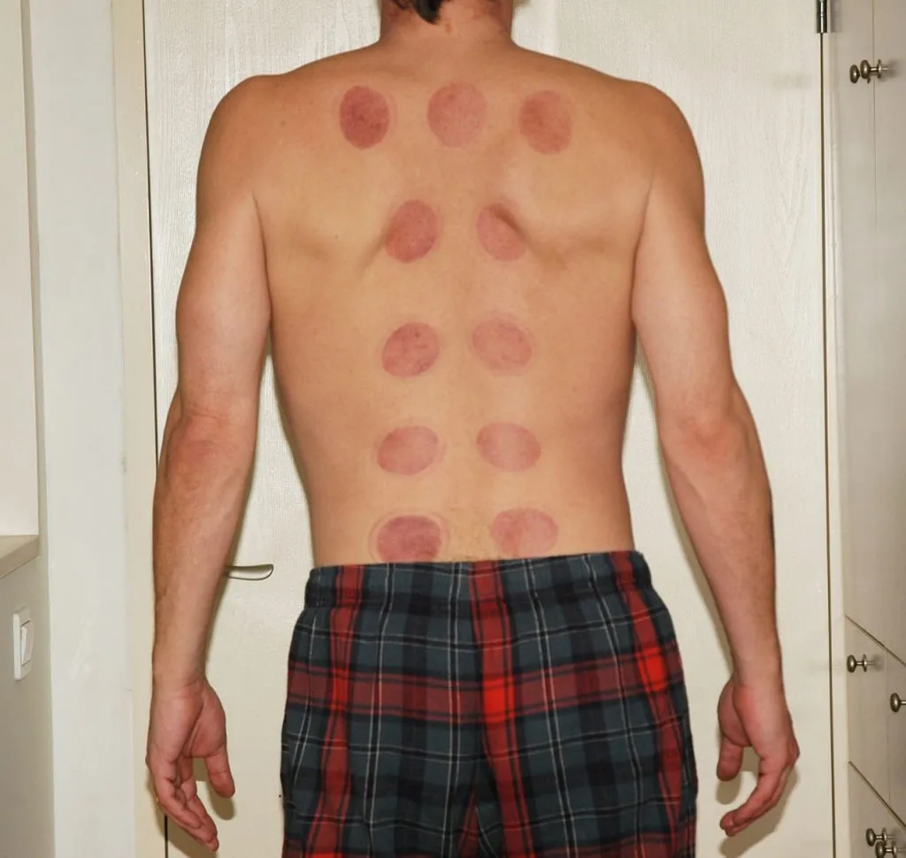 Chinese medicine 1601201198 טיפול כוסות רוח