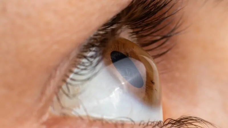 קרטוקונוס e1705777867133 קרטוקונוס