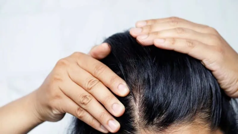 Hair Loss 1 e1664337237128 איבוד שיער