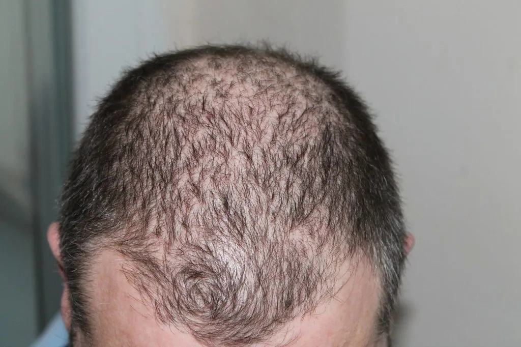 Hair Loss 1643595954 שיער דליל