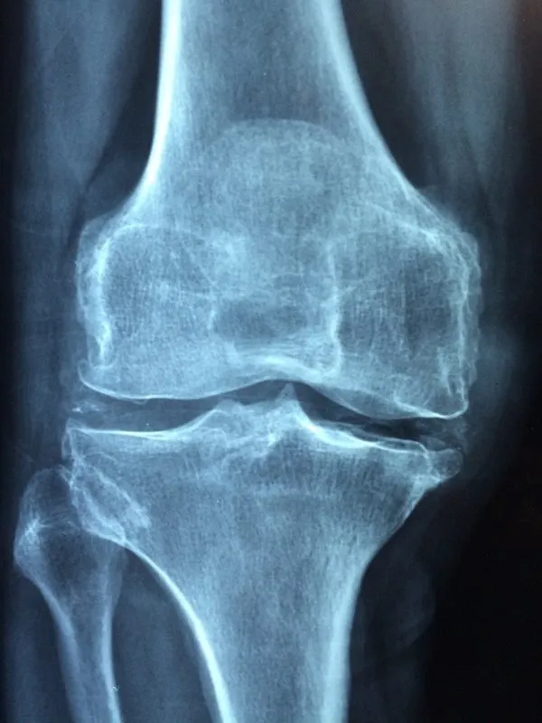 knee pain 1622688013 e1622688036333 עצם