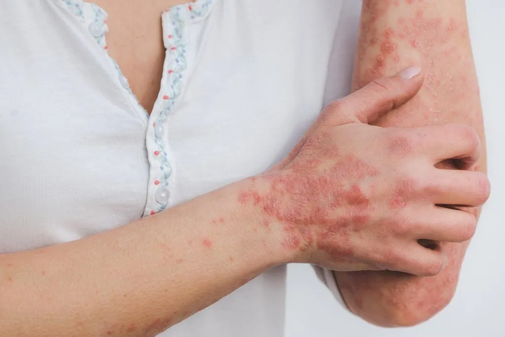 skin disease 1661159310 גרדת על העור